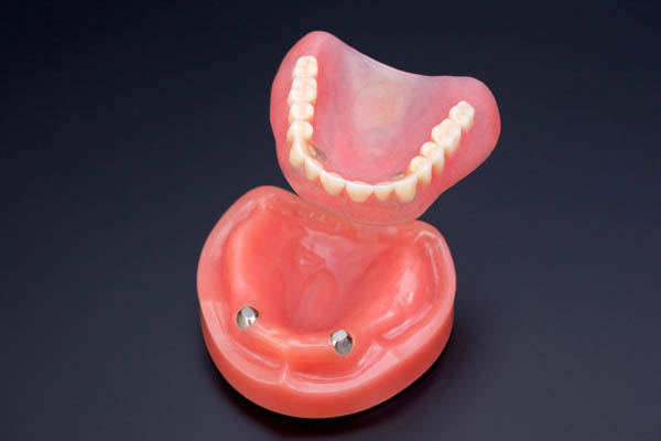 磁性（磁石式）アタッチメント義歯